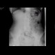 Pneumatosis of small bowel, meteorism: X-ray - Plain radiograph
